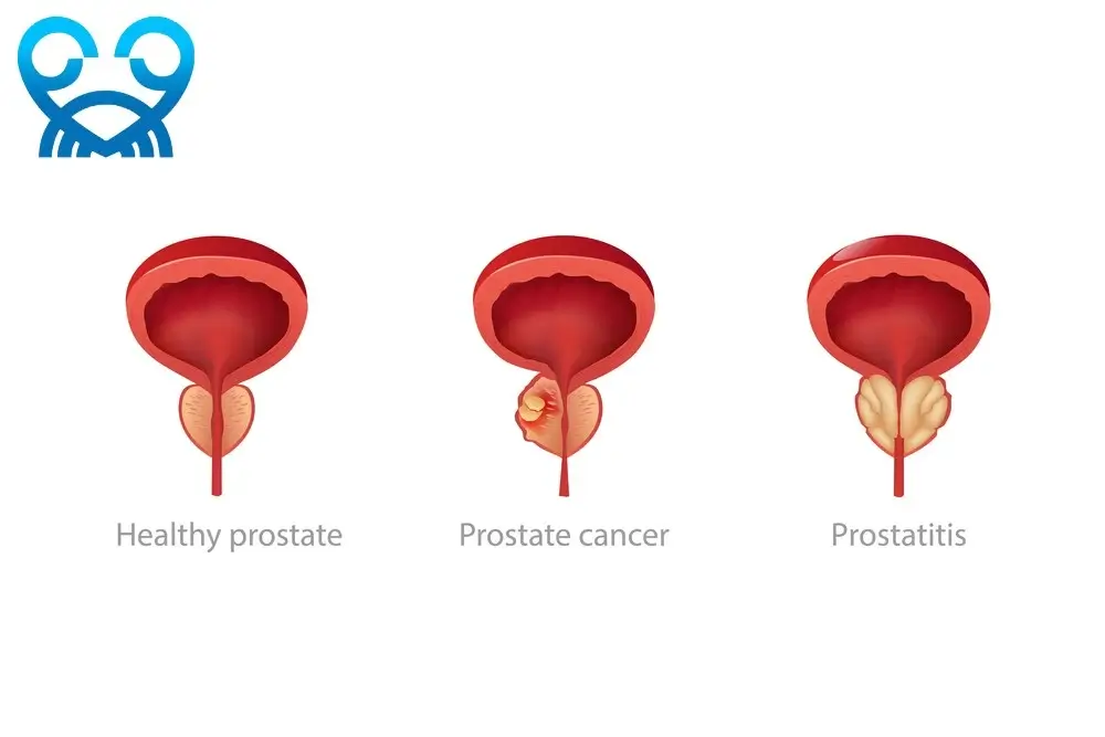 سرطان پروستات