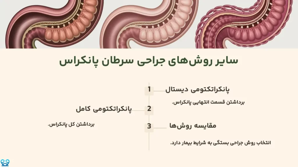 سایر روشهای جراحی سرطان پانکراس