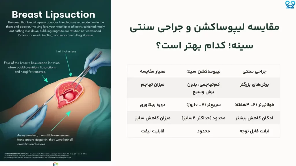 لیپوساکشن سینه