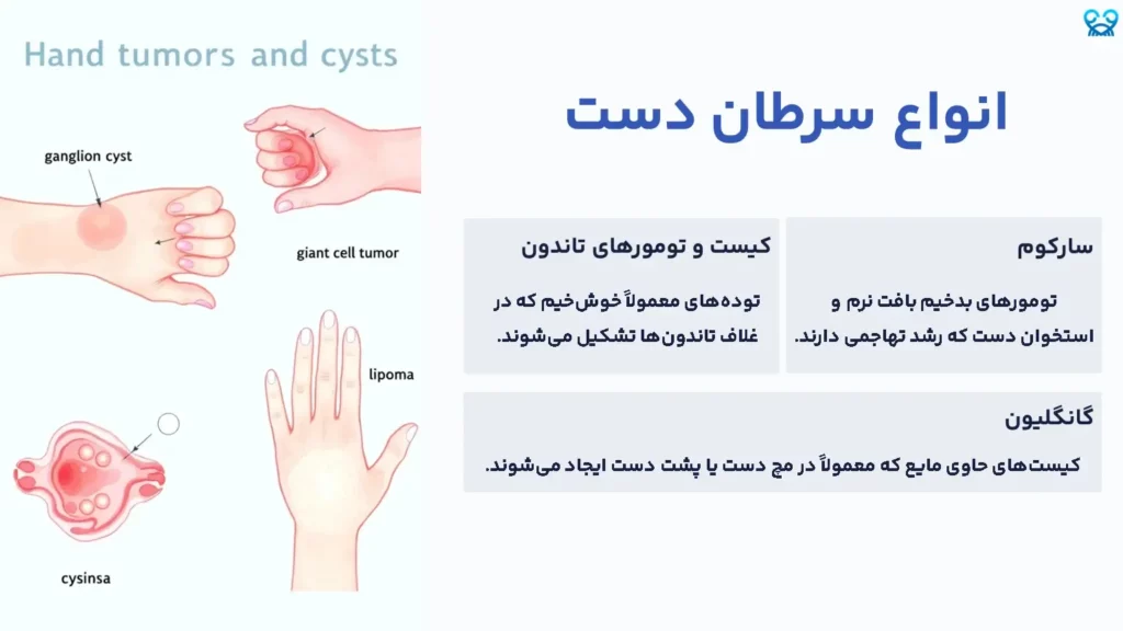 سرطان دست