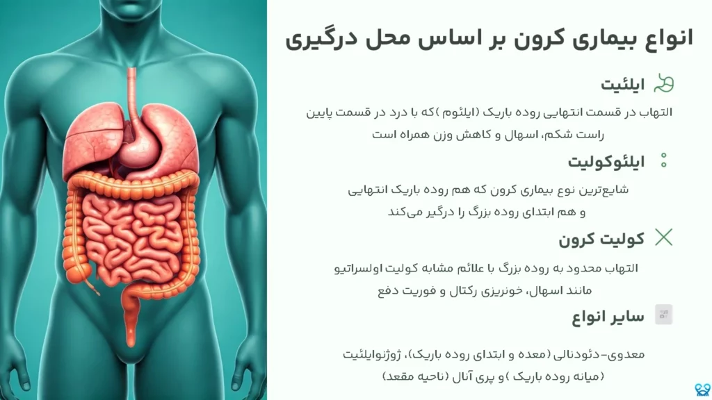 بیماری کرون