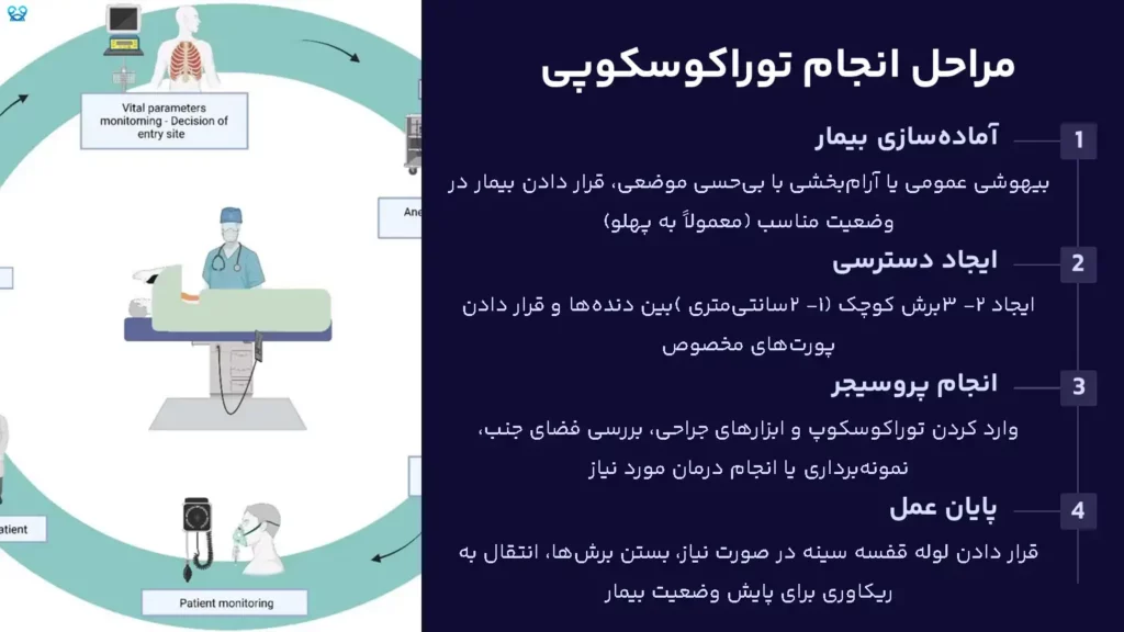 توراکوسکوپی