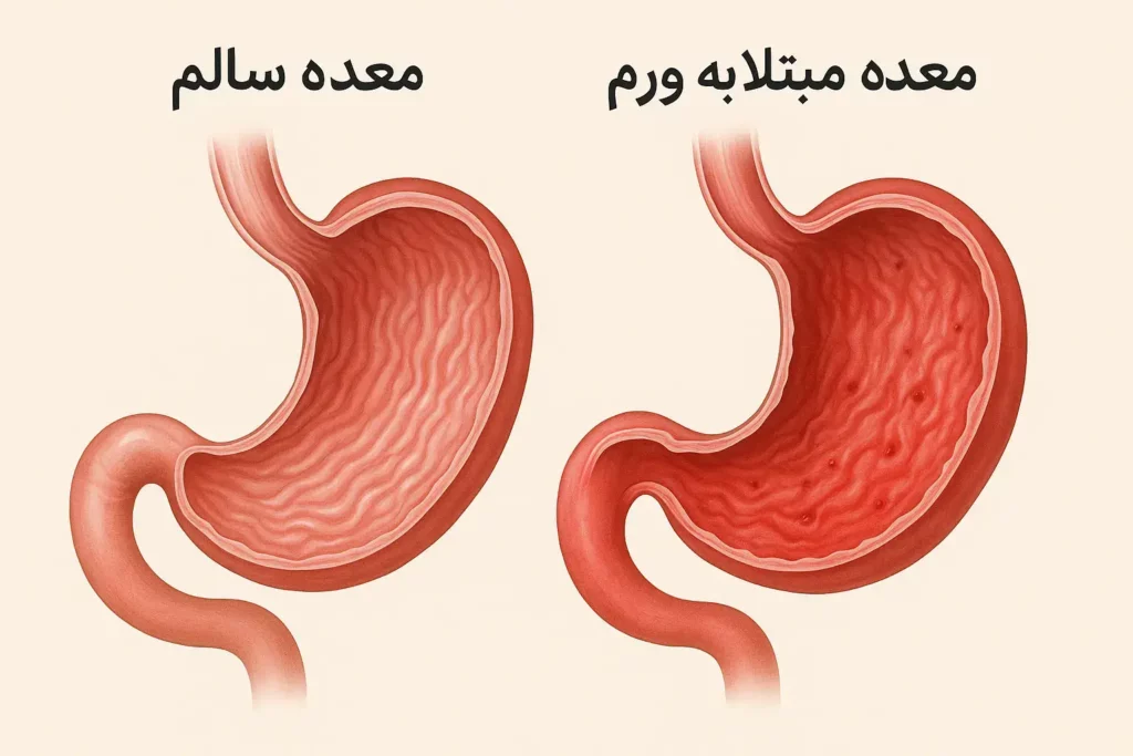 ورم معده