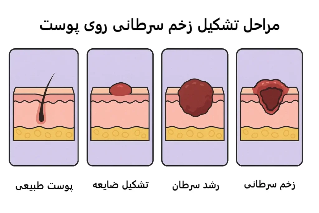 مراحل تشکیل زخم سرطانی