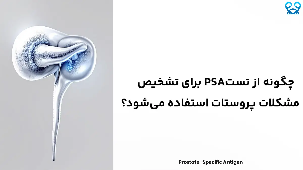 تست PSA، یکی از روش‌های تشخیص زودهنگام سرطان پروستات