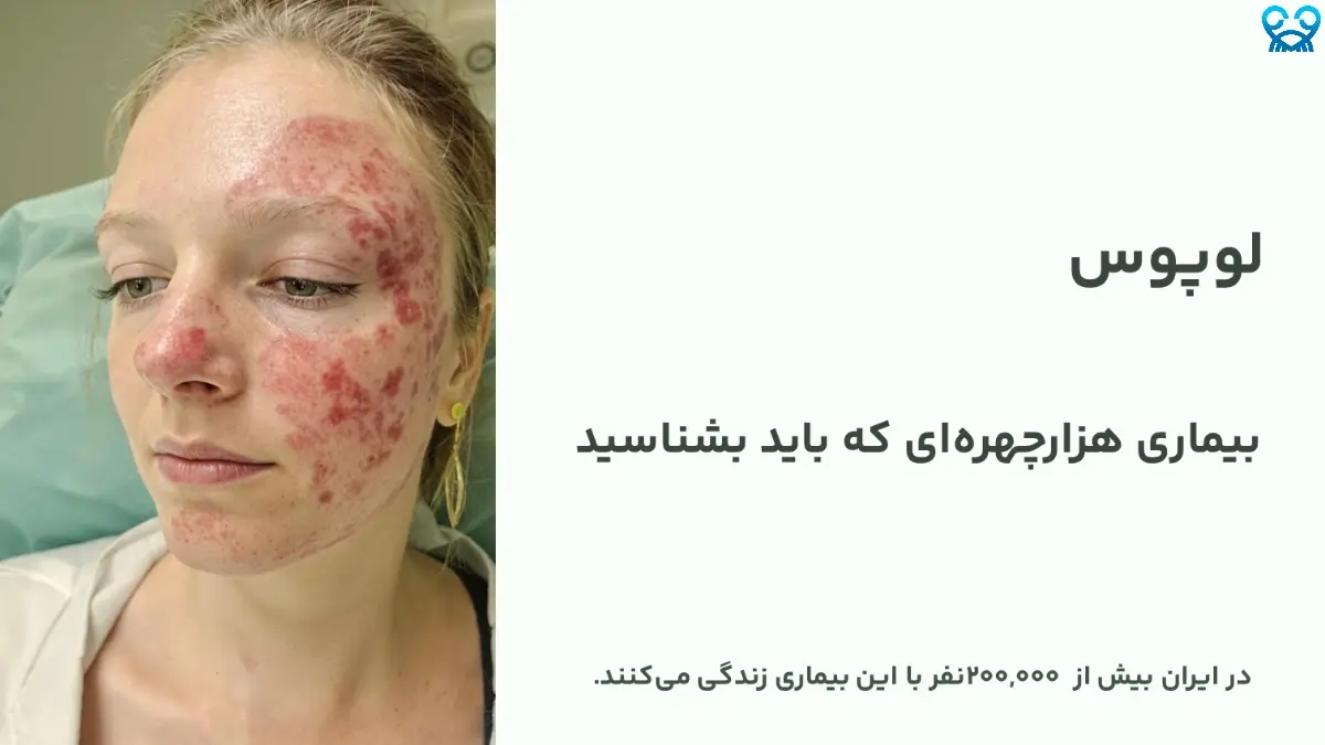 لوپوس چیست و چه علائمی دارد؟