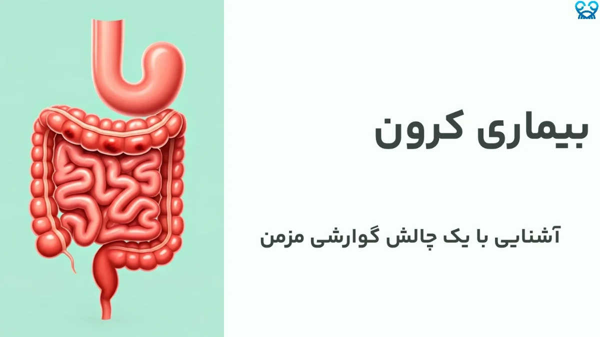 بیماری کرون چیست و چگونه کنترل می‌شود؟