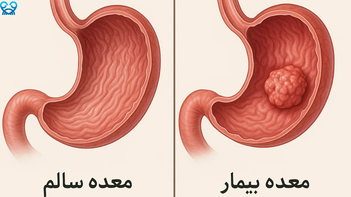 علائم هشداردهنده و روش‌های تشخیص سرطان معده