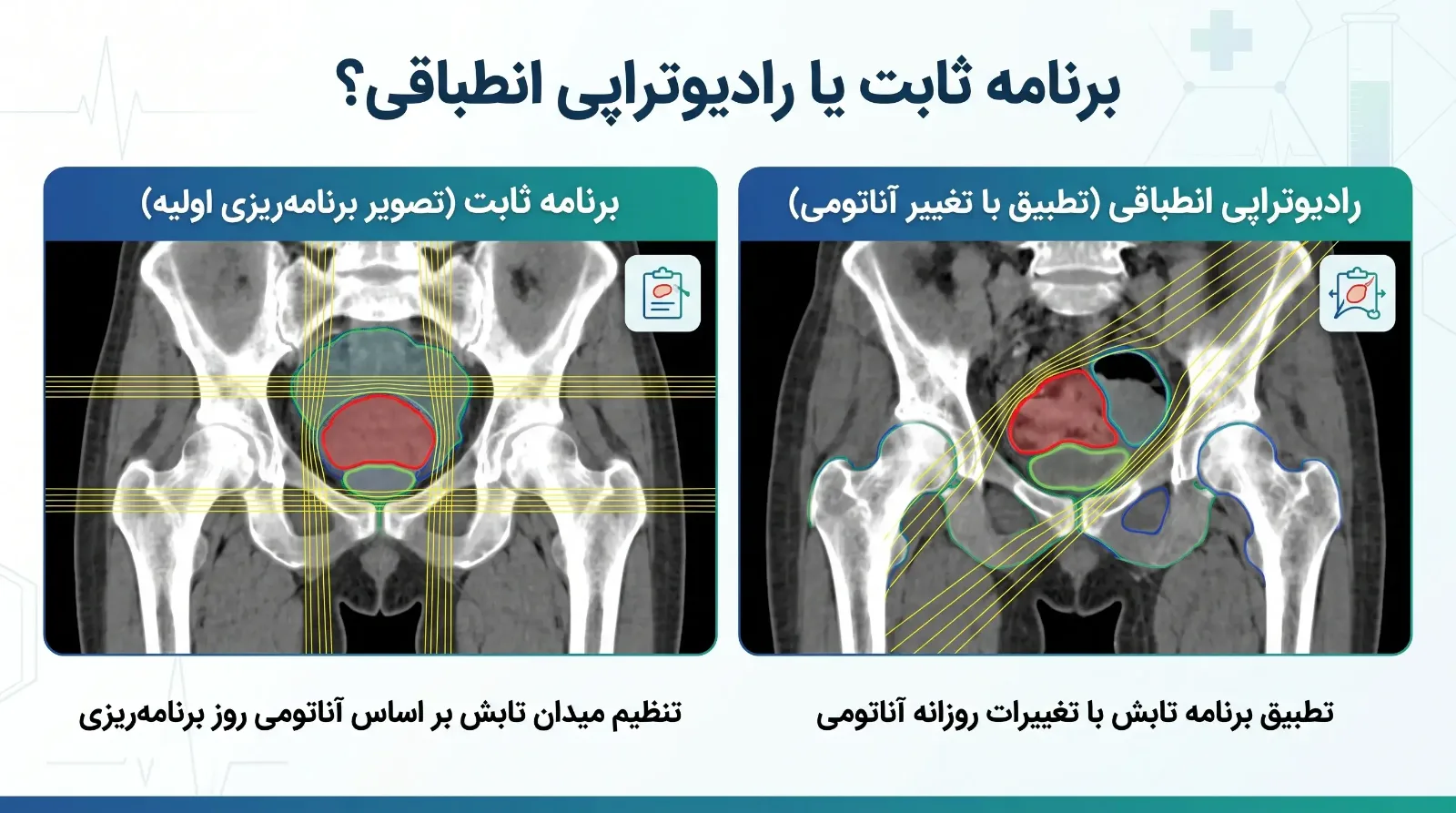 رادیوتراپی انطباقی (ART)