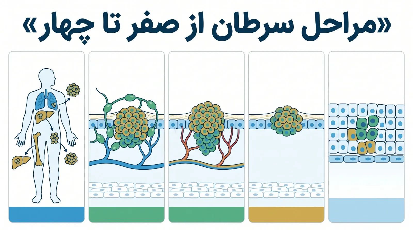 مراحل سرطان