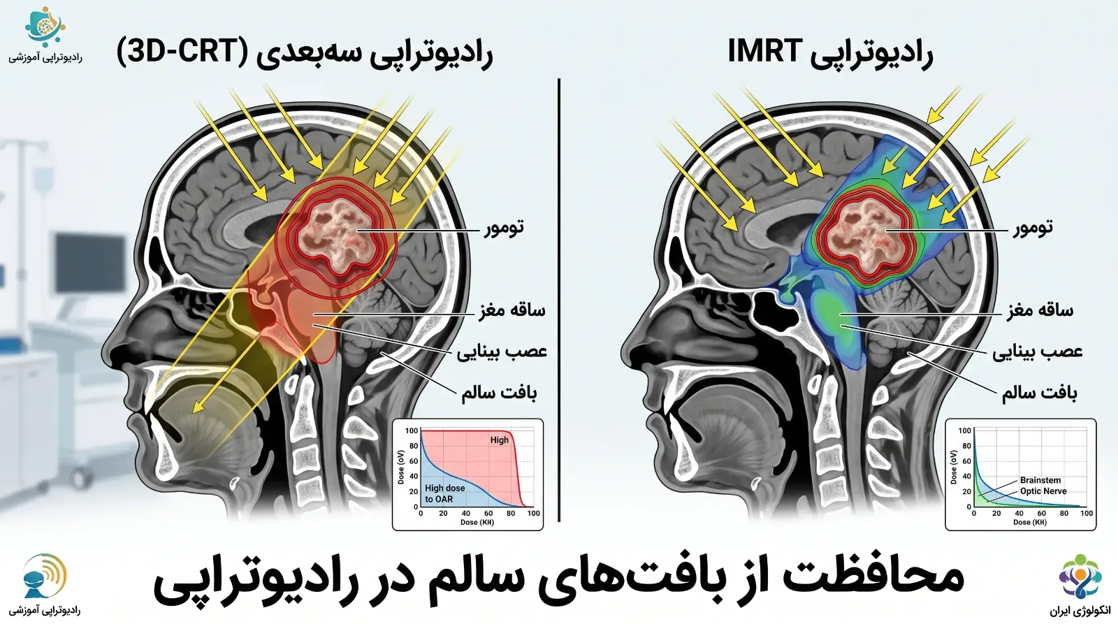 تفاوت رادیوتراپی سه‌بعدی (3D-CRT) و IMRT
