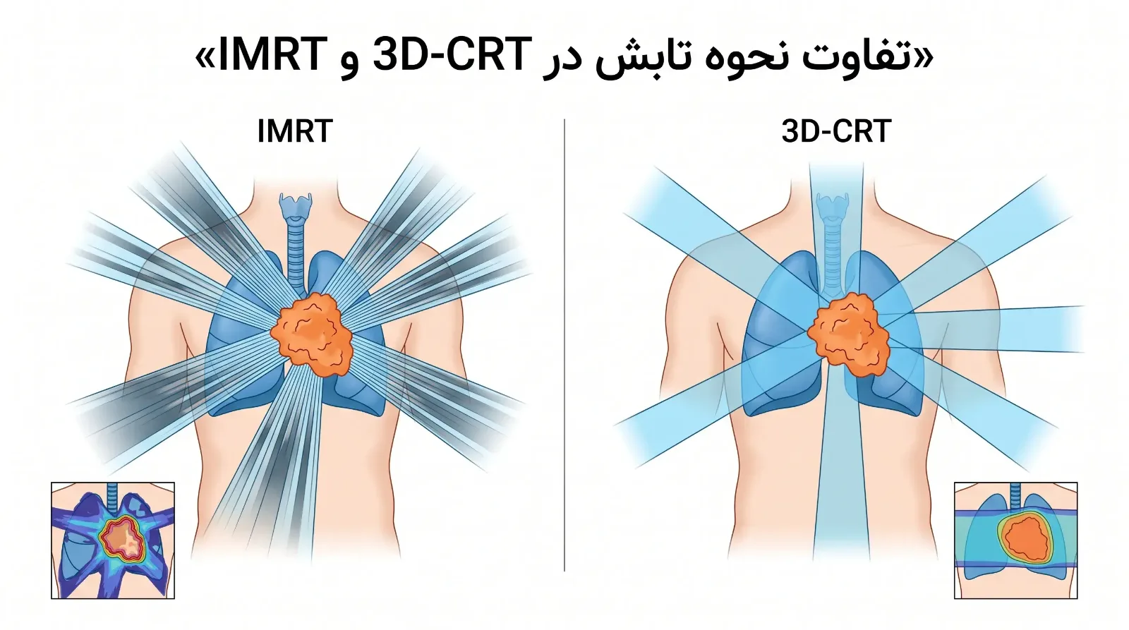 تفاوت رادیوتراپی سه‌بعدی (3D-CRT) و IMRT