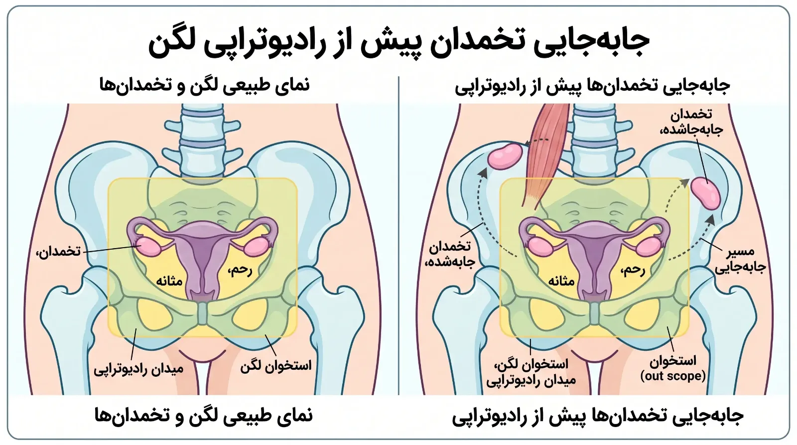 حفظ باروری در بیماران سرطان لگن