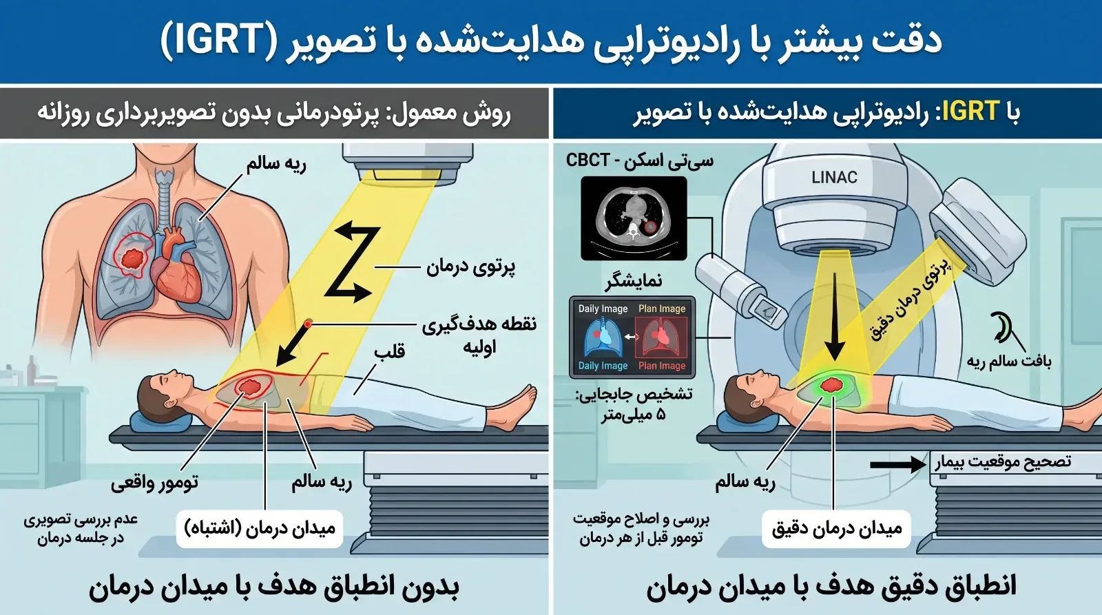رادیوتراپی دقیق (IGRT)