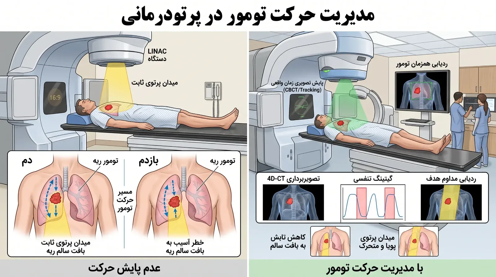 رادیوتراپی دقیق (IGRT)
