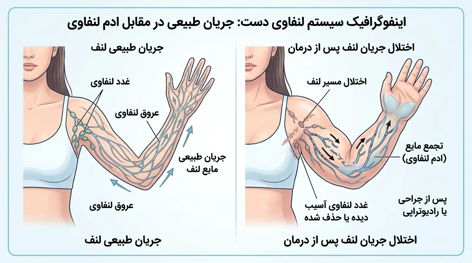 لنف‌ادم بعد از رادیوتراپی