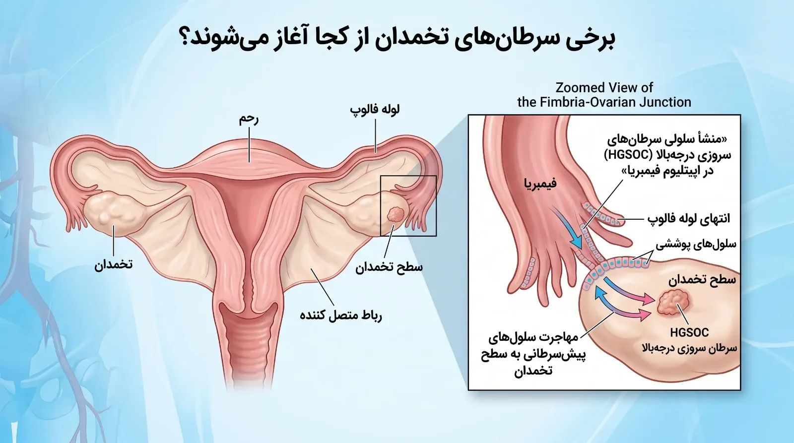 چرا تشخیص زودهنگام سرطان تخمدان دشوار است؟