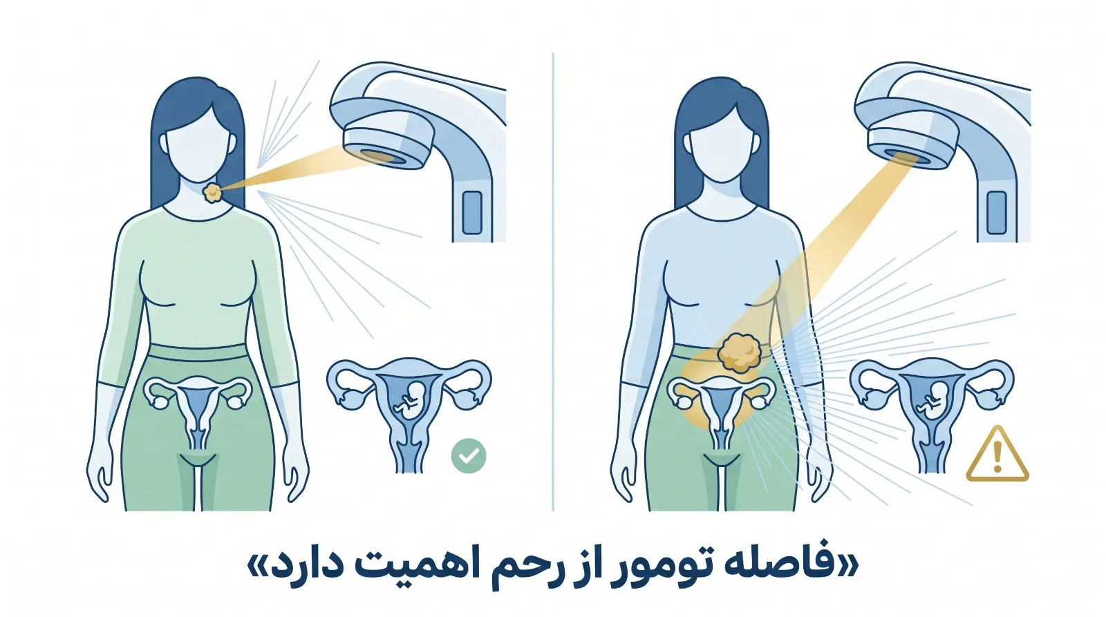 رادیوتراپی در دوران بارداری